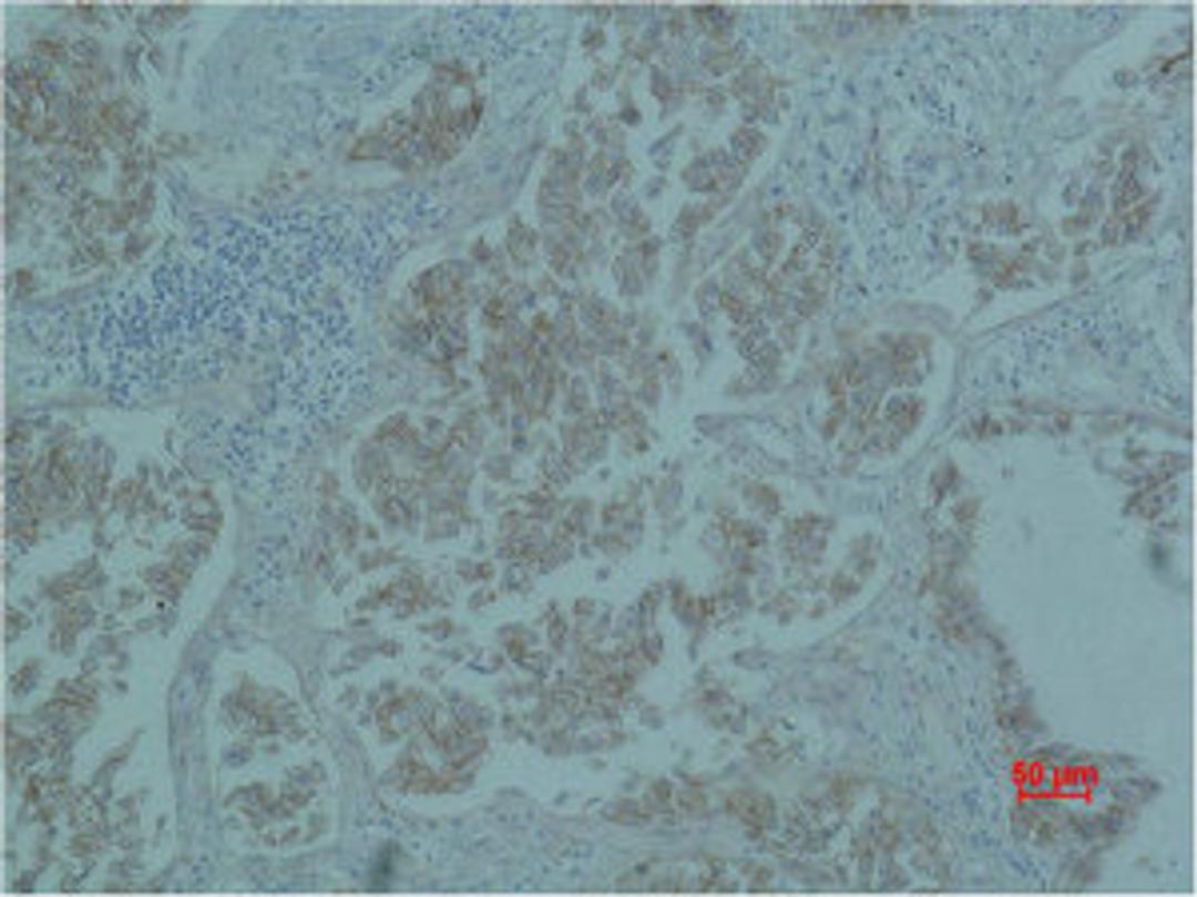 Immunohistochemical analysis of paraffin-embedded Human Lung caricnoma using Catenin-β Monoclonal Antibody.