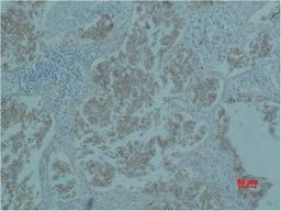 Immunohistochemical analysis of paraffin-embedded Human Lung caricnoma using Catenin-β Monoclonal Antibody.