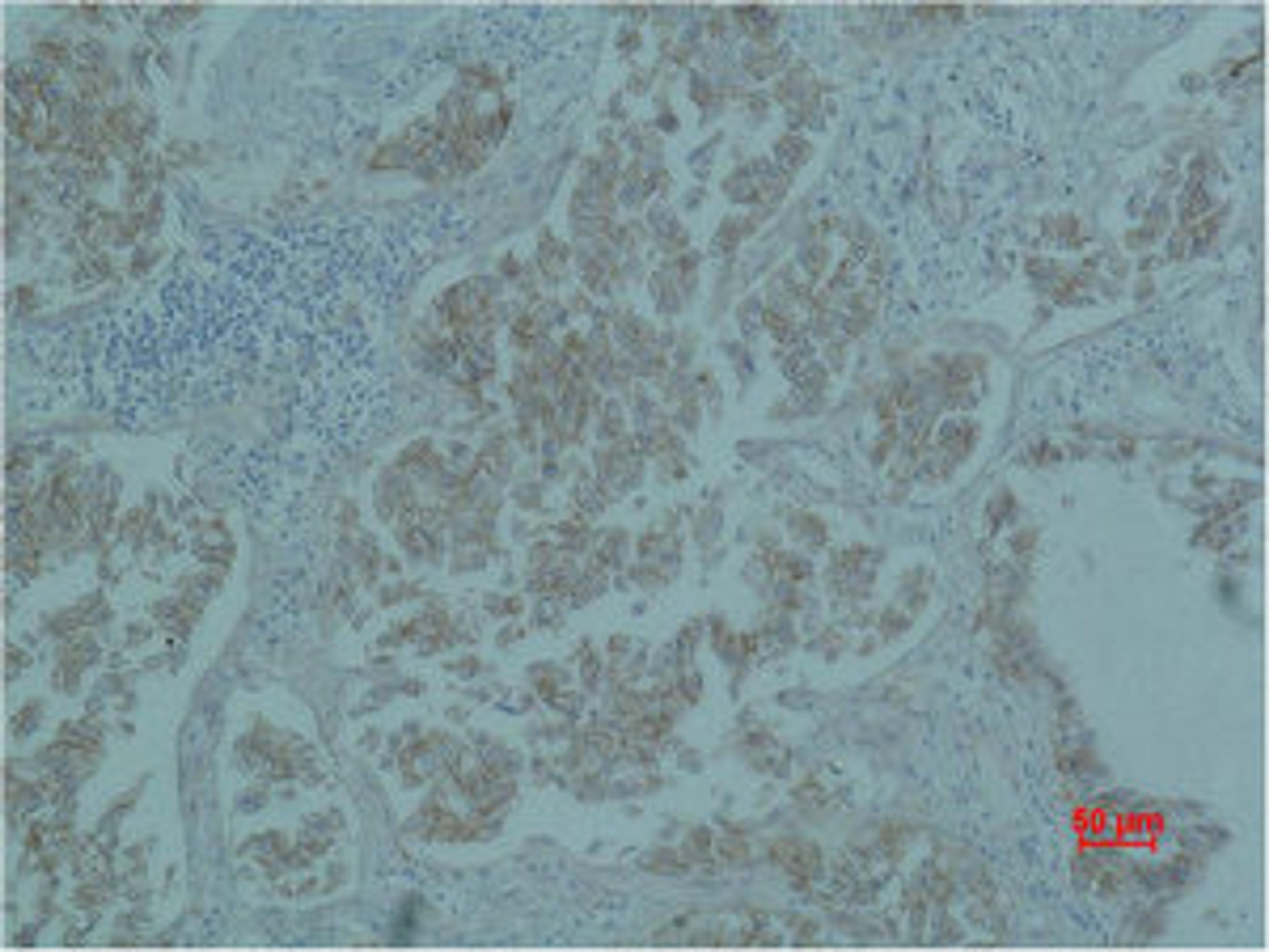 Immunohistochemical analysis of paraffin-embedded Human Lung caricnoma using Catenin-β Monoclonal Antibody.