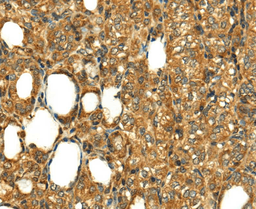 Immunohistochemical analysis of paraffin-embedded Human thyroid cancer tissue using RLN1 antibody