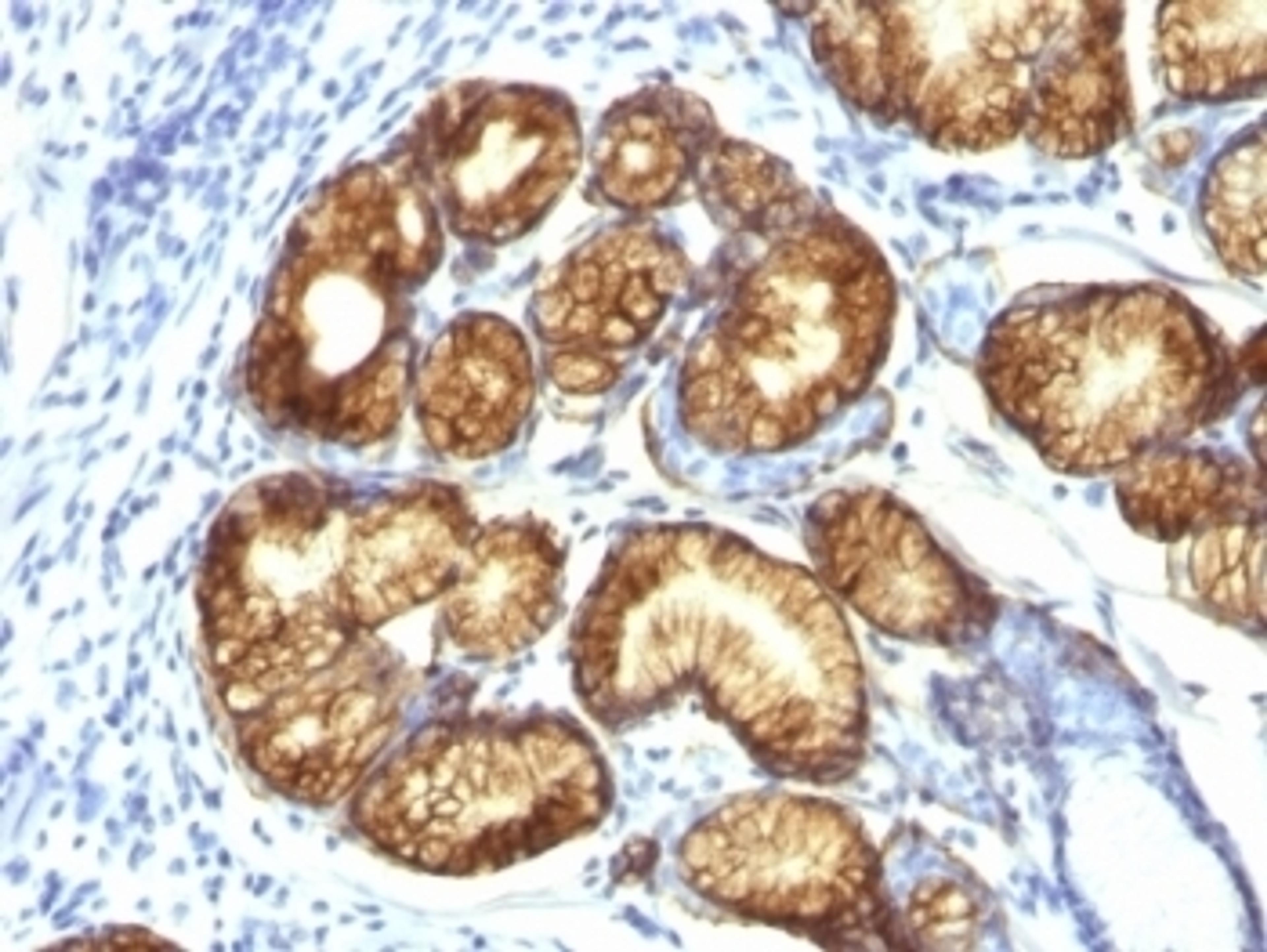 Formalin-fixed, paraffin-embedded human gastric carcinoma stained with MUC6 antibody (CLH5).