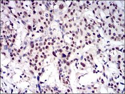 Immunohistochemistry: CTNNBL1 Antibody (1E4F5) [NBP2-37252] - Immunohistochemical analysis of paraffin-embedded esophageal cancer tissues using CTNNBL1 mouse mAb with DAB staining.