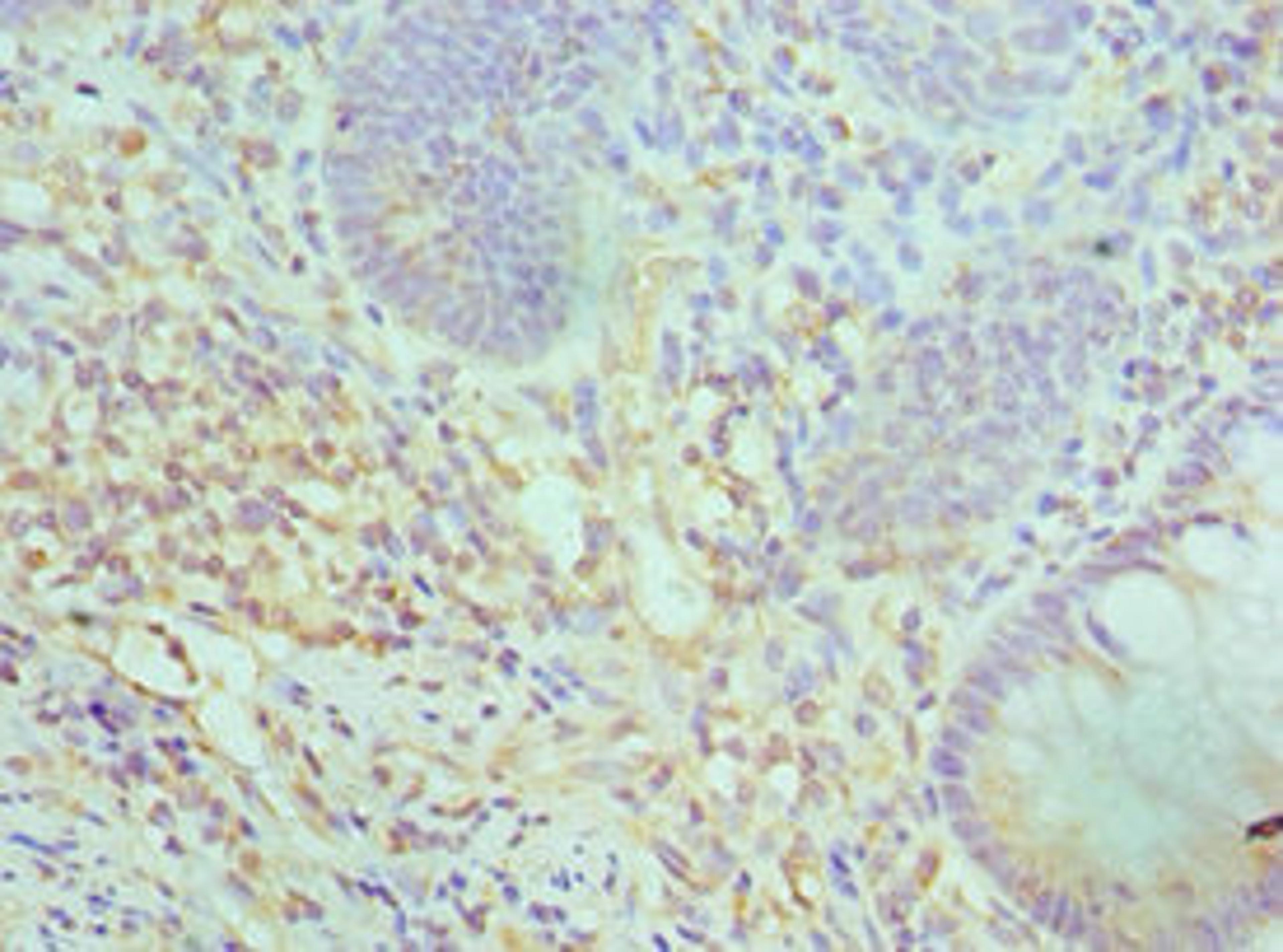Immunohistochemistry of paraffin-embedded human colon cancer using CSB-PA851527ESR2HU at dilution of 1:100