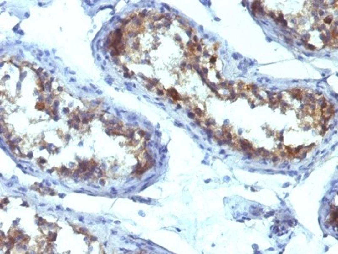 Immunohistochemistry-Paraffin: Alkaline Phosphatase, Intestinal Antibody (ALPI/597) [NBP2-44960] - Human Testicular Carcinoma stained with Alkaline Phosphatase Monoclonal Antibody (ALPI/597).