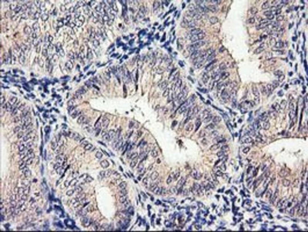 Immunohistochemistry-Paraffin: Cytochrome p450 2J2 Antibody (5C5) [NBP2-01286] - Staining of paraffin-embedded Adenocarcinoma of Human endometrium tissue using anti-Cytochrome p450 2J2 mouse monoclonal antibody.