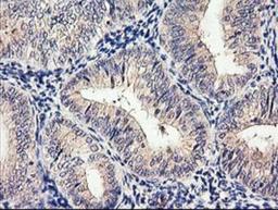 Immunohistochemistry-Paraffin: Cytochrome p450 2J2 Antibody (5C5) [NBP2-01286] - Staining of paraffin-embedded Adenocarcinoma of Human endometrium tissue using anti-Cytochrome p450 2J2 mouse monoclonal antibody.