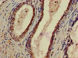 Immunohistochemistry of paraffin-embedded human prostate cancer using CSB-PA017319LA01HU at dilution of 1:100