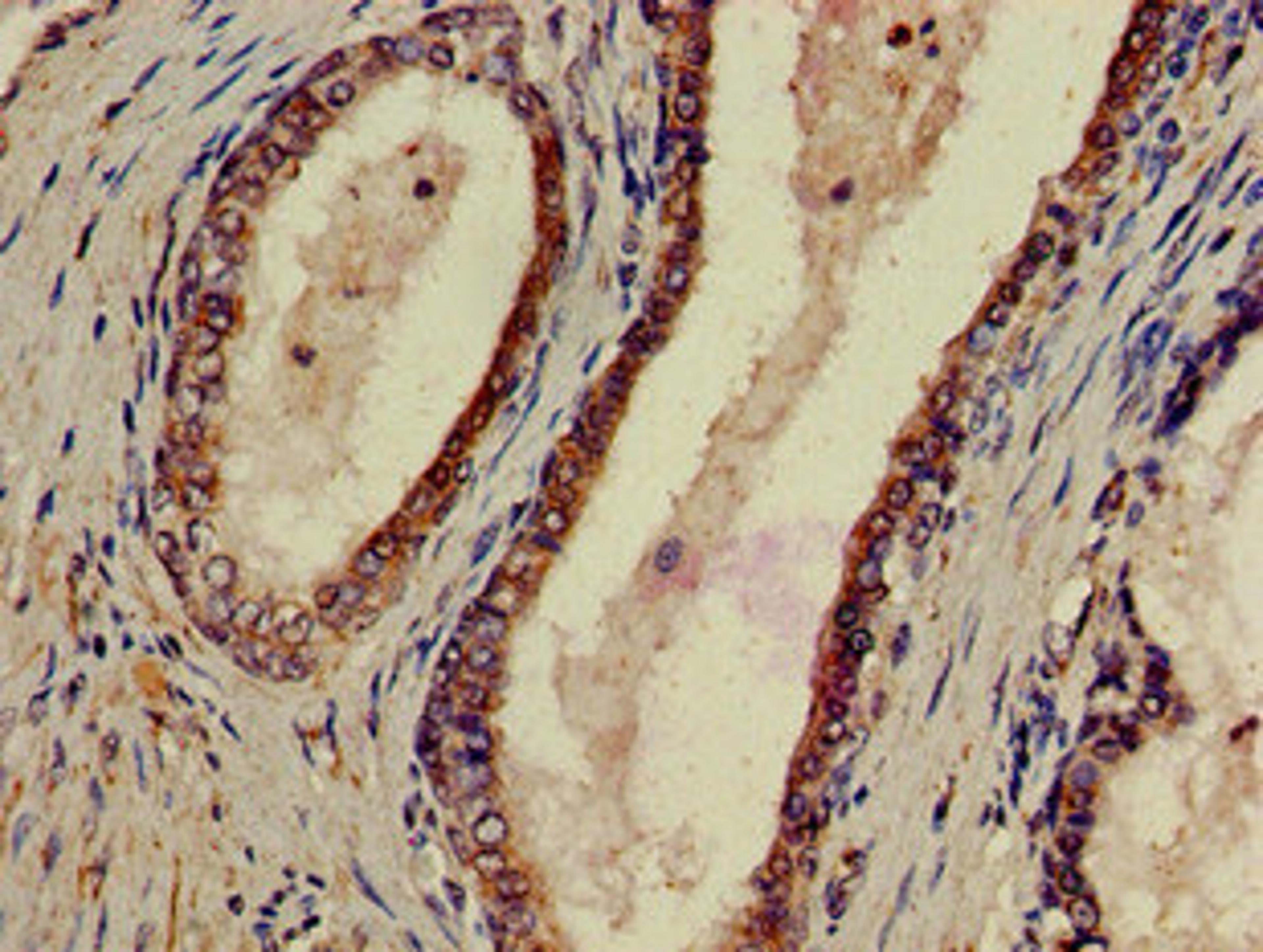 Immunohistochemistry of paraffin-embedded human prostate cancer using CSB-PA017319LA01HU at dilution of 1:100