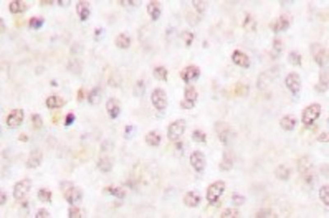 Immunohistochemistry: IkB beta [p Ser23] Antibody [NB100-92564] - Immunohistochemistry (IHC) analyzes of p-I kappa B-alpha  (S23) antibody in paraffin-embedded human breast  carcinoma tissue.