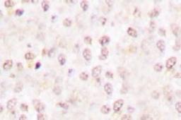 Immunohistochemistry: IkB beta [p Ser23] Antibody [NB100-92564] - Immunohistochemistry (IHC) analyzes of p-I kappa B-alpha  (S23) antibody in paraffin-embedded human breast  carcinoma tissue.