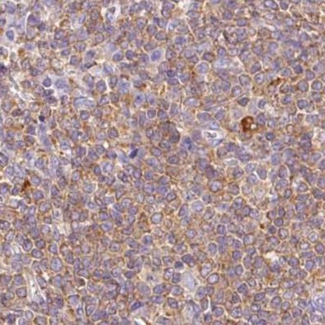 Immunohistochemistry: DOK6 Antibody [NBP2-32609] - lymphoma