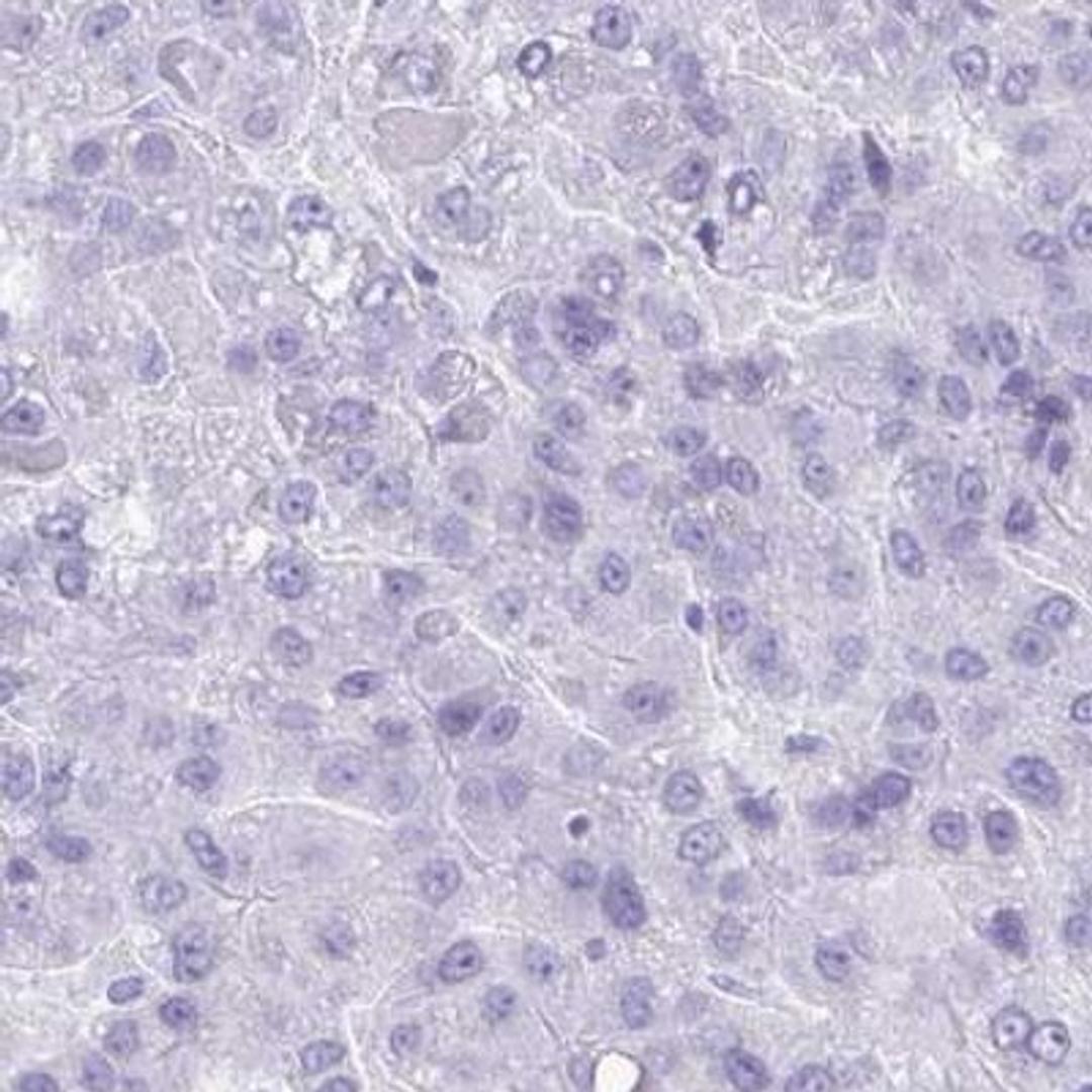 Immunohistochemistry: SEL1L2 Antibody [NBP2-32426] - liver cancer