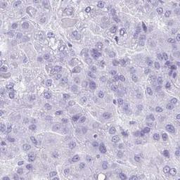 Immunohistochemistry: SEL1L2 Antibody [NBP2-32426] - liver cancer