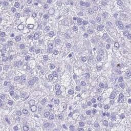 Immunohistochemistry-Paraffin: MYADML2 Antibody [NBP2-33526] - liver cancer