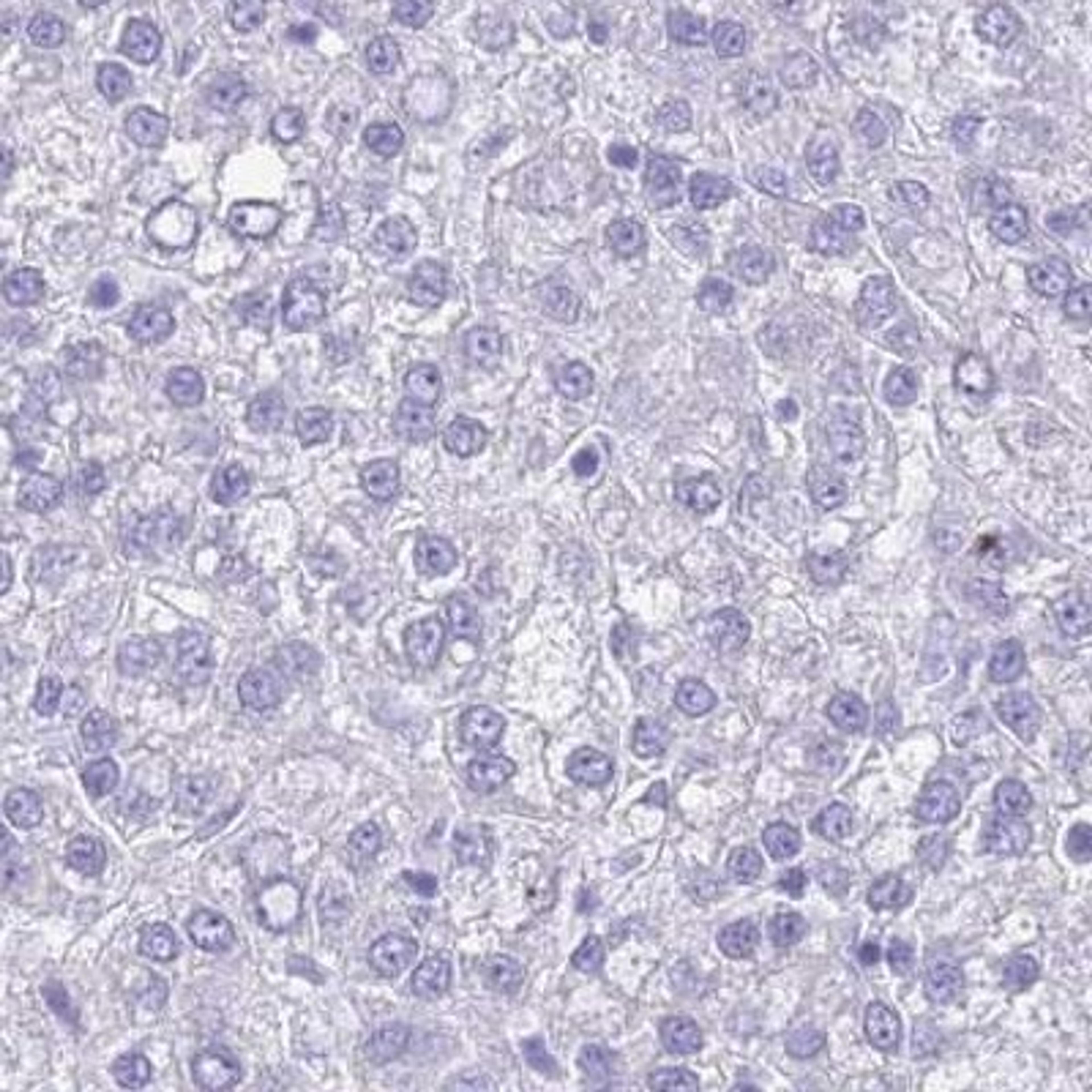 Immunohistochemistry-Paraffin: MYADML2 Antibody [NBP2-33526] - liver cancer