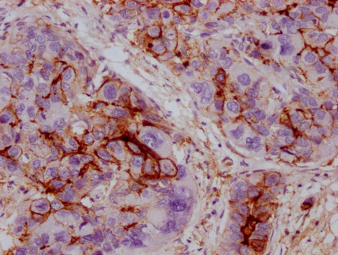 IHC image of CSB-MA211660 diluted at 1:100 and staining in paraffin-embedded human liver cancer performed on a Leica BondTM system. After dewaxing and hydration, antigen retrieval was mediated by high pressure in a citrate buffer (pH 6.0). Section was blocked with 10% normal goat serum 30min at RT. Then primary antibody (1% BSA) was incubated at 4°C overnight. The primary is detected by a Goat anti-mouse IgG polymer labeled by HRP and visualized using 0.05% DAB.