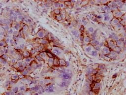 IHC image of CSB-MA211660 diluted at 1:100 and staining in paraffin-embedded human liver cancer performed on a Leica BondTM system. After dewaxing and hydration, antigen retrieval was mediated by high pressure in a citrate buffer (pH 6.0). Section was blocked with 10% normal goat serum 30min at RT. Then primary antibody (1% BSA) was incubated at 4°C overnight. The primary is detected by a Goat anti-mouse IgG polymer labeled by HRP and visualized using 0.05% DAB.