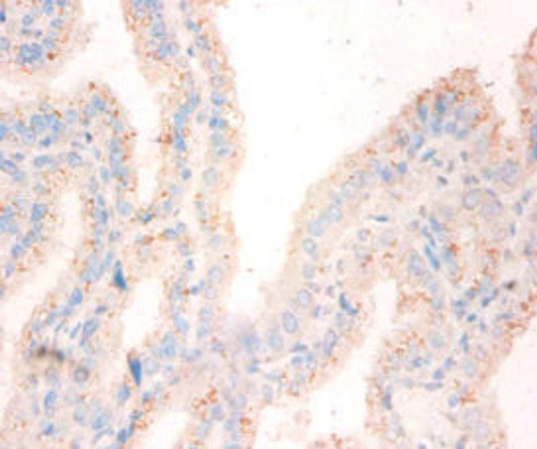 Immunohistochemistry of paraffin-embedded human bladder cancer using CSB-PA02775A0Rb at dilution of 1:50
