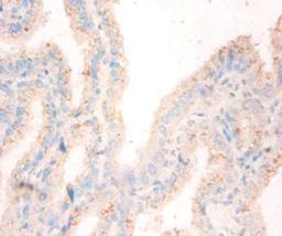 Immunohistochemistry of paraffin-embedded human bladder cancer using CSB-PA02775A0Rb at dilution of 1:50