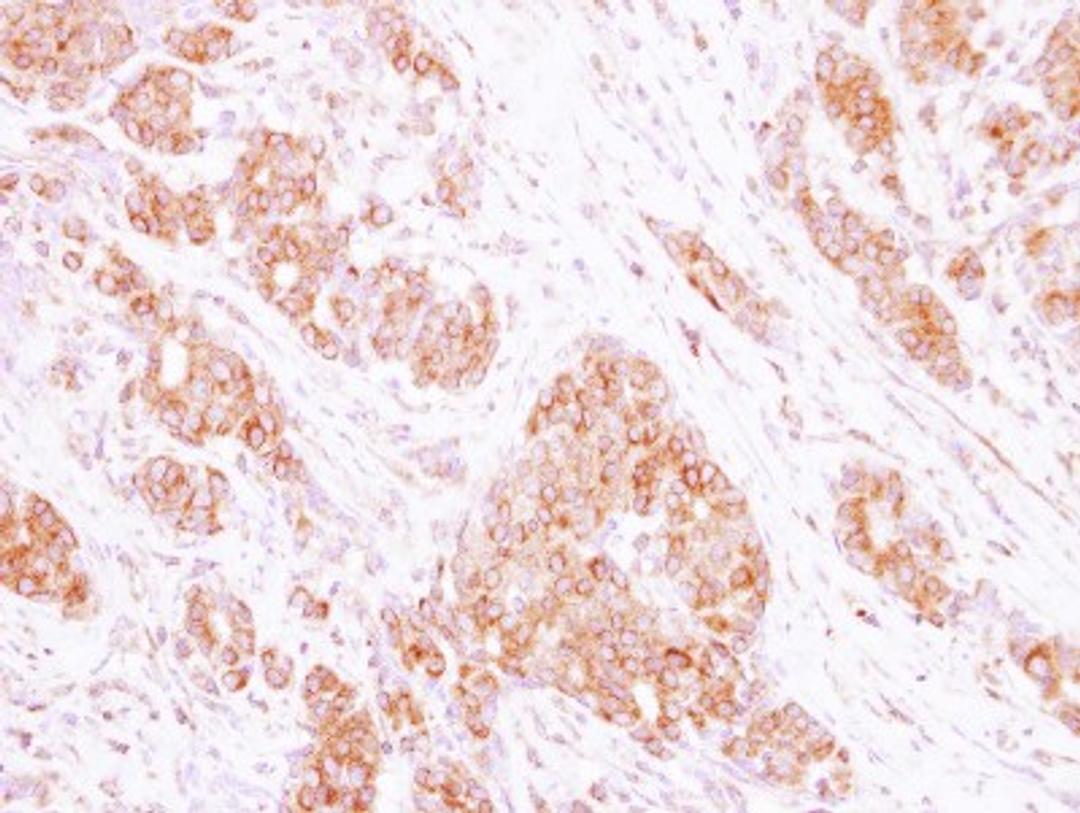 Immunohistochemistry-Paraffin: RAB35 Antibody [NBP2-20042] - Immunohistochemical analysis of paraffin-embedded Breast ca, using antibody at 1:250 dilution.