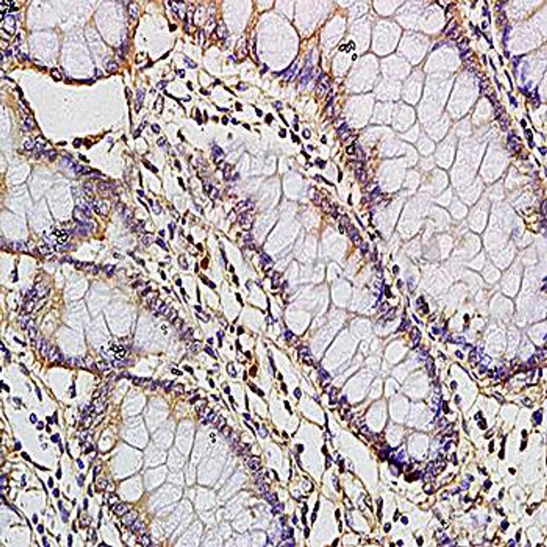 Immunohistochemical analysis of formalin-fixed and paraffin embedded human colon carcinoma tissue (dilution at:1:200) using CCL1/TCA3 antibody