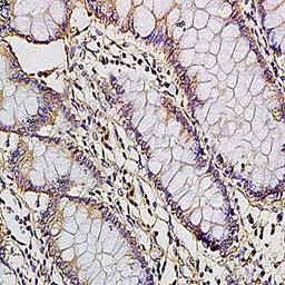 Immunohistochemical analysis of formalin-fixed and paraffin embedded human colon carcinoma tissue (dilution at:1:200) using CCL1/TCA3 antibody