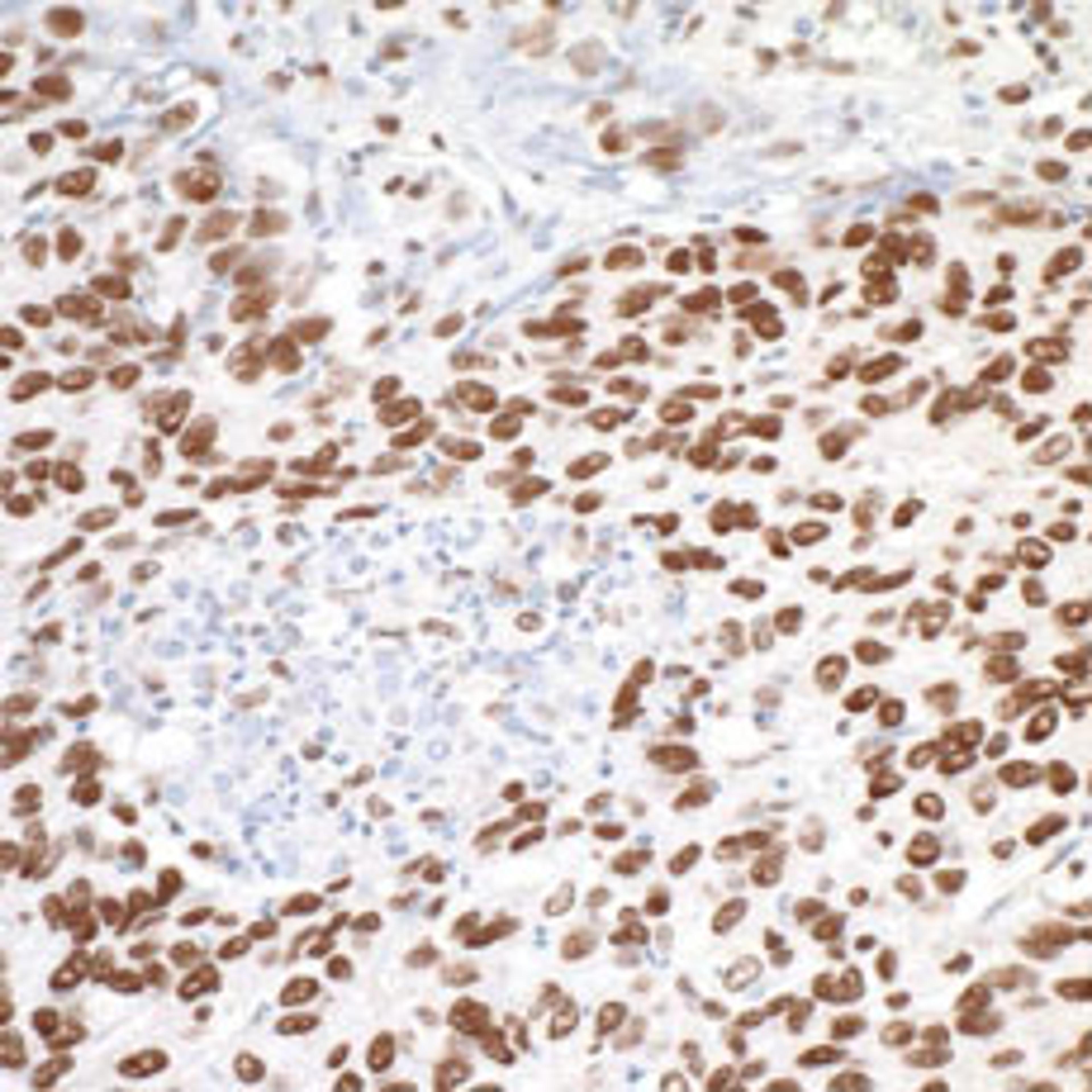 Detection of human MTA1 by immunohistochemistry.