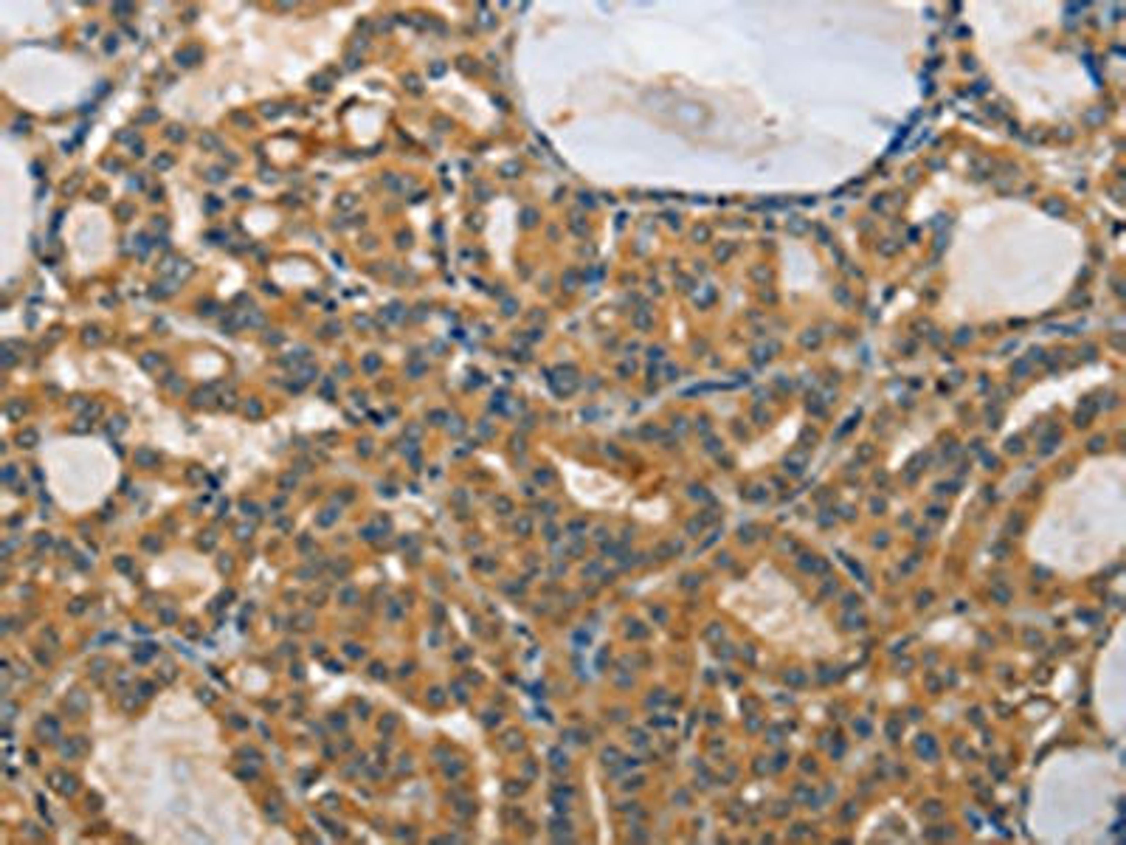 The image on the left is immunohistochemistry of paraffin-embedded Human thyroid cancer tissue using CSB-PA346286(RPS27 Antibody) at dilution 1/25, on the right is treated with fusion protein. (Original magnification: ×200)