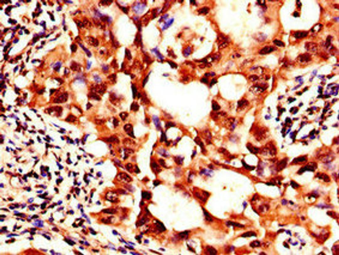 Immunohistochemistry of paraffin-embedded human lung cancer using CSB-PA021321LA01HU at dilution of 1:100
