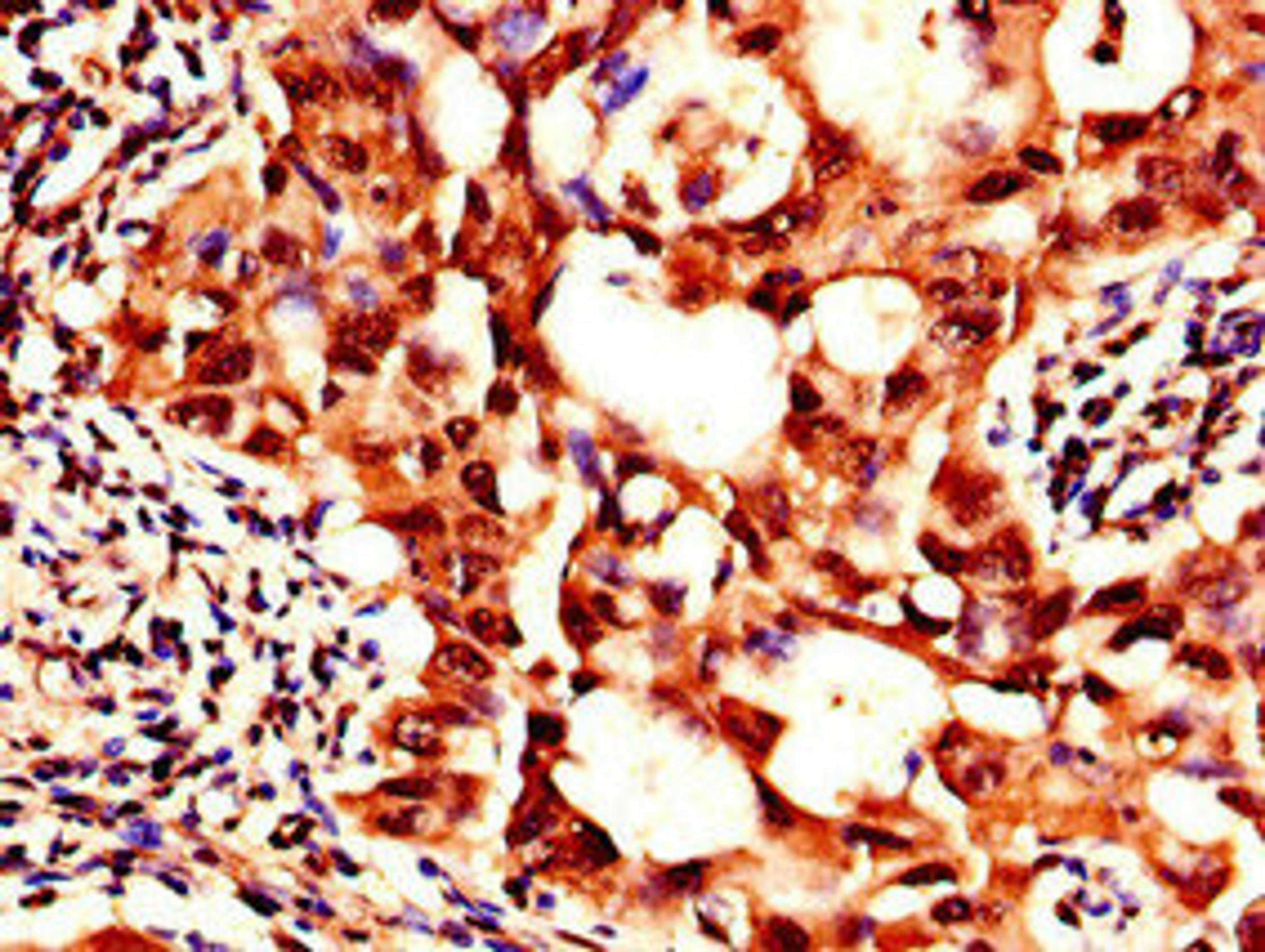 Immunohistochemistry of paraffin-embedded human lung cancer using CSB-PA021321LA01HU at dilution of 1:100