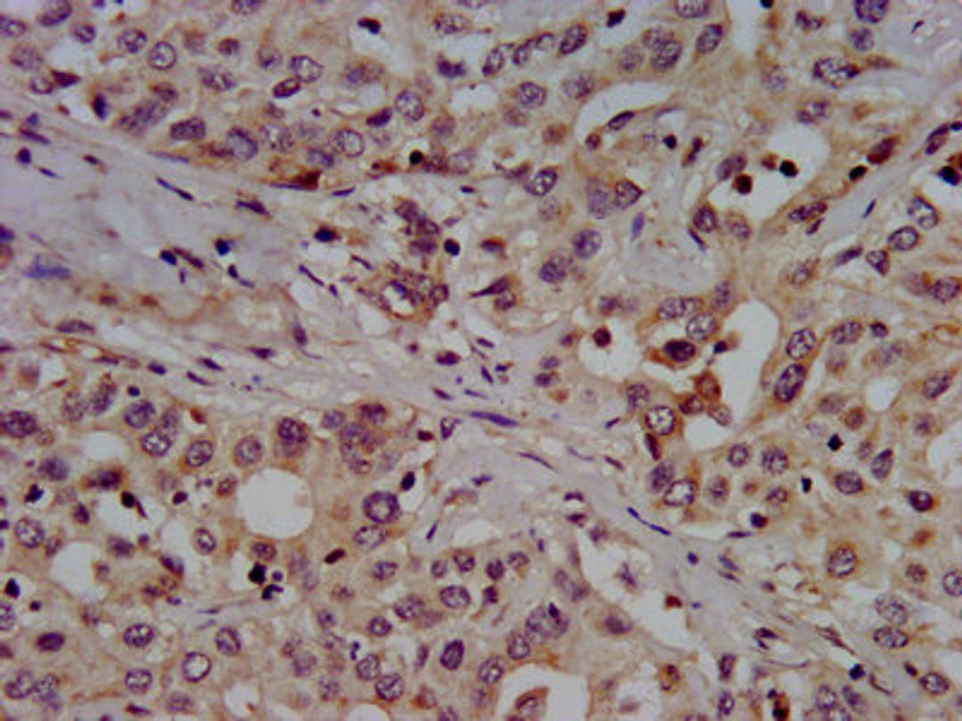 IHC image of CSB-PA021709LA01HU diluted at 1:500 and staining in paraffin-embedded human liver cancer performed on a Leica BondTM system. After dewaxing and hydration, antigen retrieval was mediated by high pressure in a citrate buffer (pH 6.0). Section was blocked with 10% normal goat serum 30min at RT. Then primary antibody (1% BSA) was incubated at 4°C overnight. The primary is detected by a biotinylated secondary antibody and visualized using an HRP conjugated SP system.