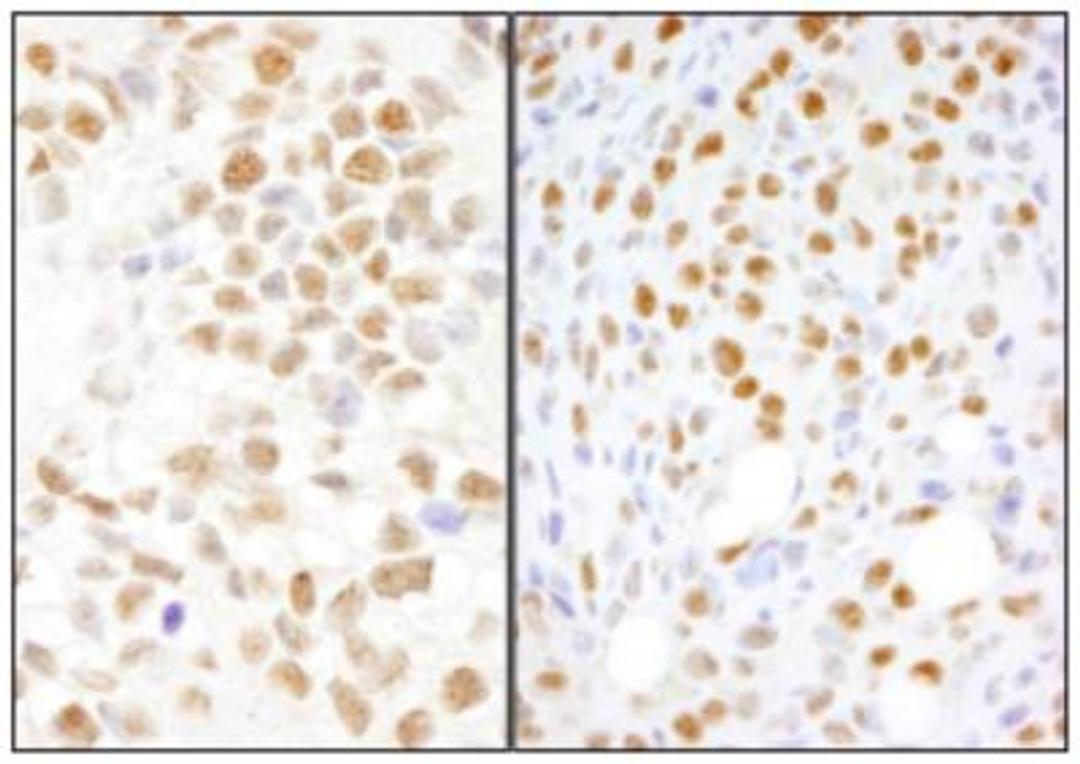 Immunohistochemistry: NONO Antibody [NB100-1556] - Section of human breast carcinoma (left) and mouse squamous cell carcinoma (right).