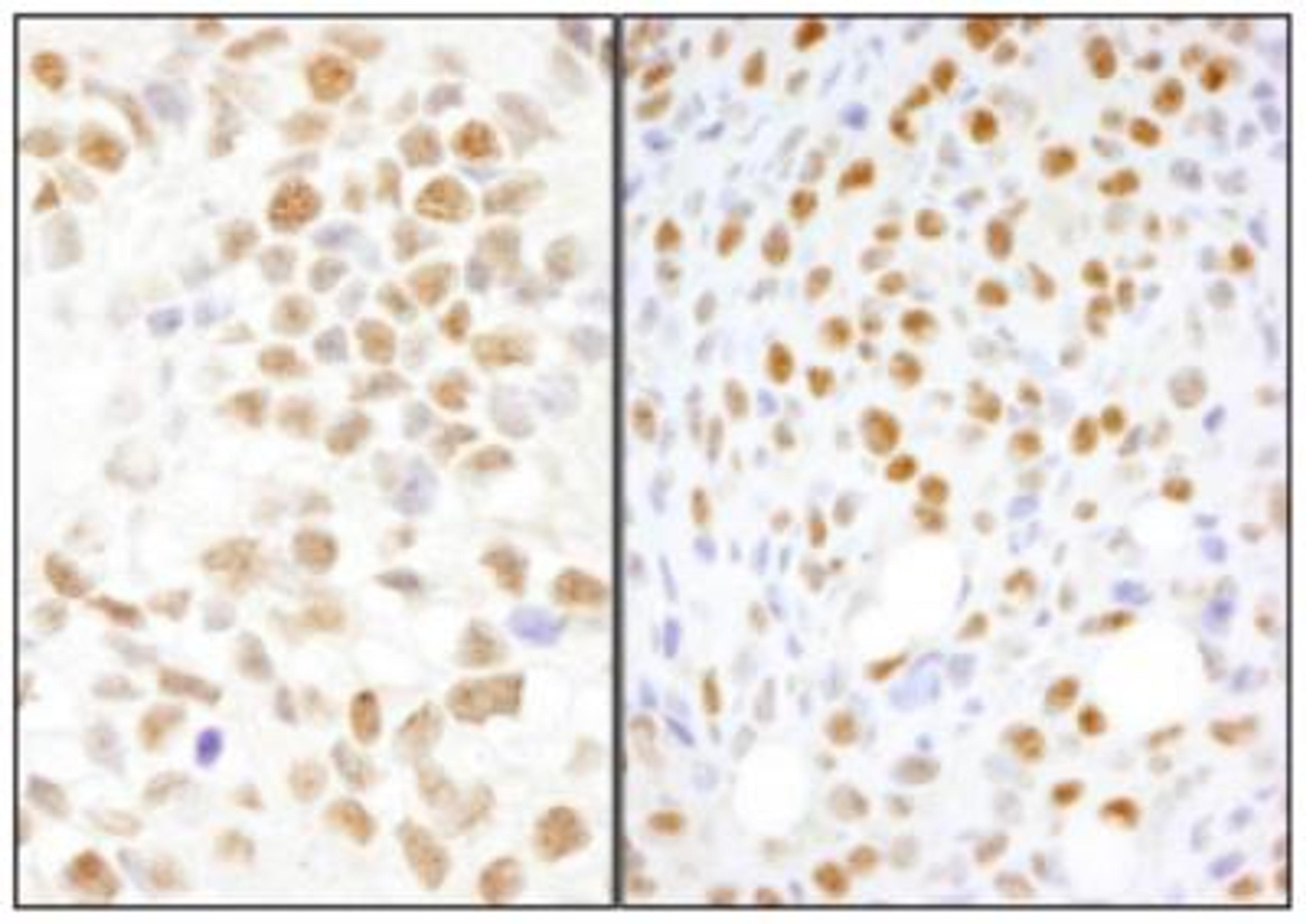 Immunohistochemistry: NONO Antibody [NB100-1556] - Section of human breast carcinoma (left) and mouse squamous cell carcinoma (right).