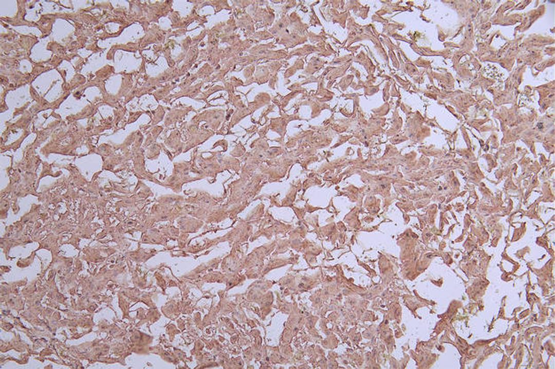 IHC image of CSB-RA042122A0HU diluted at 1:50 and staining in paraffin-embedded human liver cancer performed on a Leica BondTM system. After dewaxing and hydration, antigen retrieval was mediated by high pressure in a citrate buffer (pH 6.0). Section was blocked with 10% normal goat serum 30min at RT. Then primary antibody (1% BSA) was incubated at 4°C overnight. The primary is detected by a Goat anti-rabbit polymer IgG labeled by HRP and visualized using 0.71% DAB.