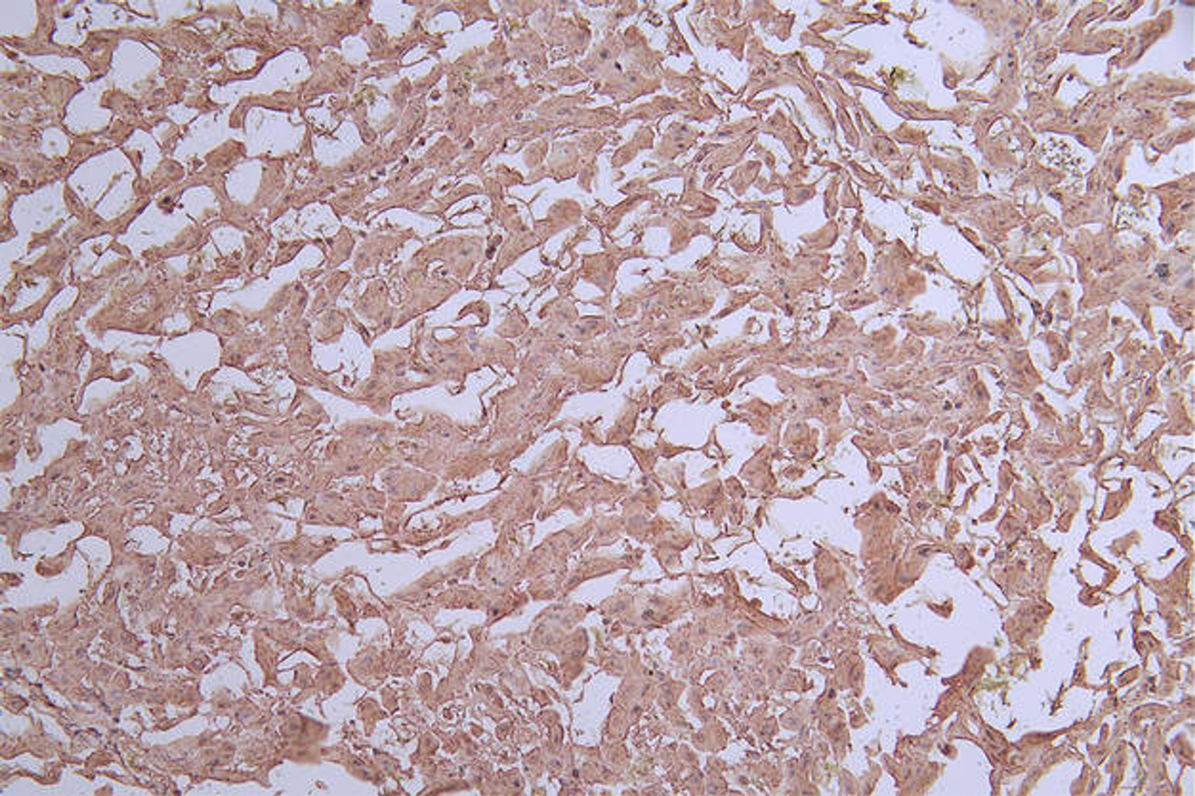 IHC image of CSB-RA042122A0HU diluted at 1:50 and staining in paraffin-embedded human liver cancer performed on a Leica BondTM system. After dewaxing and hydration, antigen retrieval was mediated by high pressure in a citrate buffer (pH 6.0). Section was blocked with 10% normal goat serum 30min at RT. Then primary antibody (1% BSA) was incubated at 4°C overnight. The primary is detected by a Goat anti-rabbit polymer IgG labeled by HRP and visualized using 0.71% DAB.