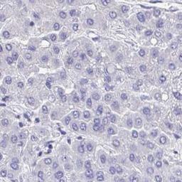 Immunohistochemistry: COA5 Antibody [NBP2-31690] - liver cancer