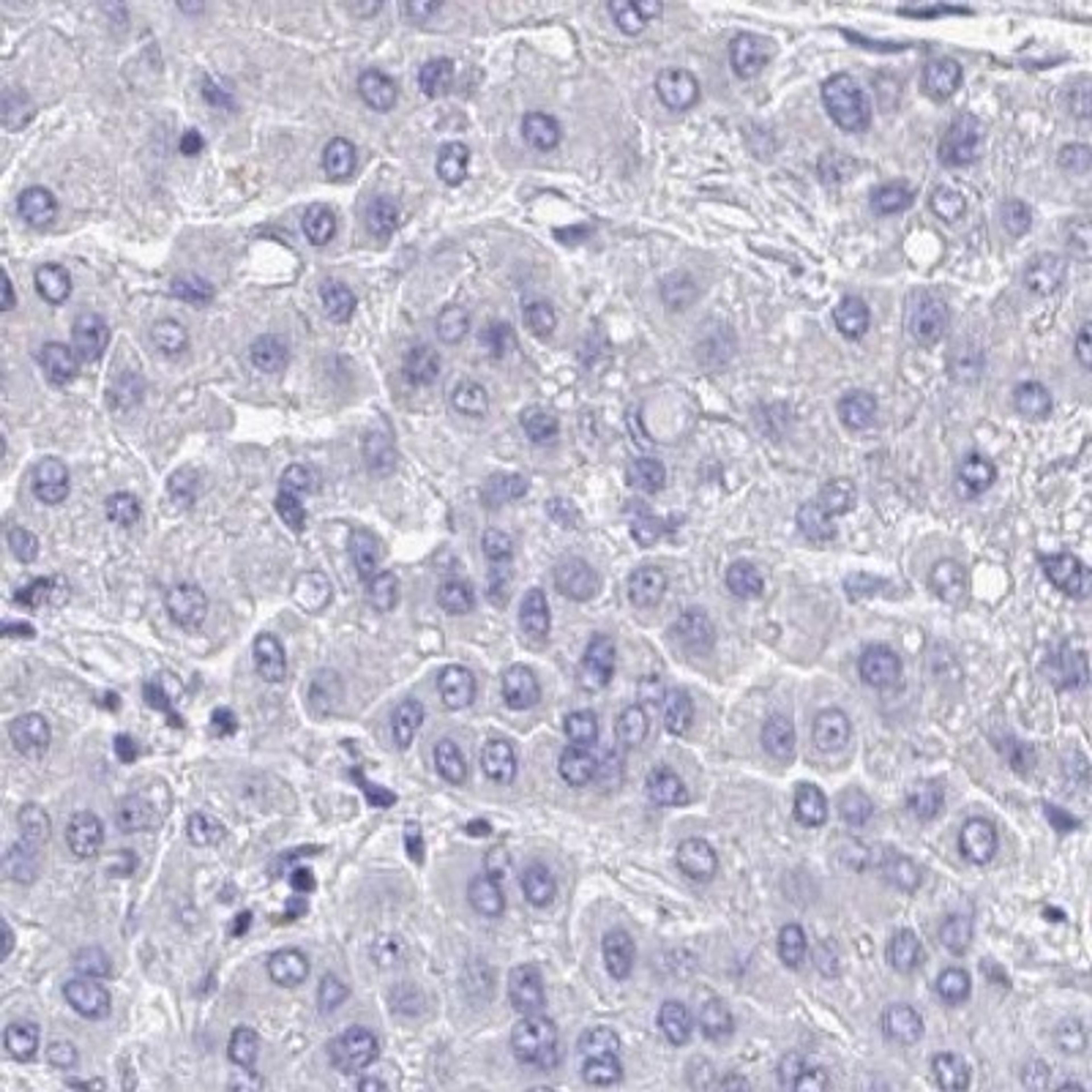 Immunohistochemistry: COA5 Antibody [NBP2-31690] - liver cancer