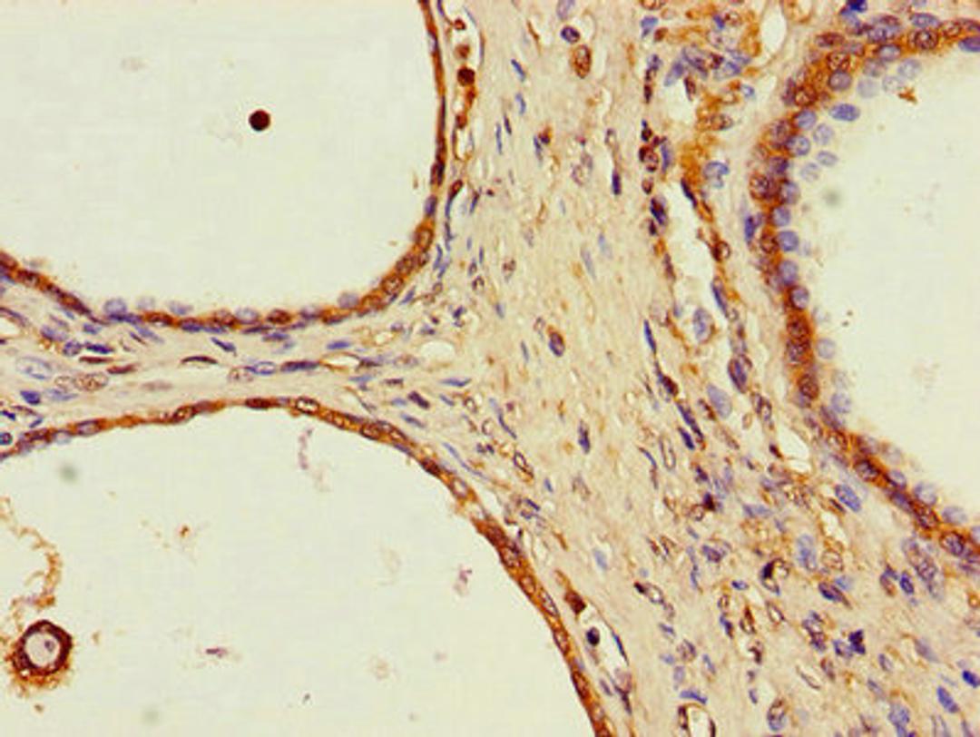 Immunohistochemistry of paraffin-embedded human prostate cancer using CSB-PA855050LA01HU at dilution of 1:100