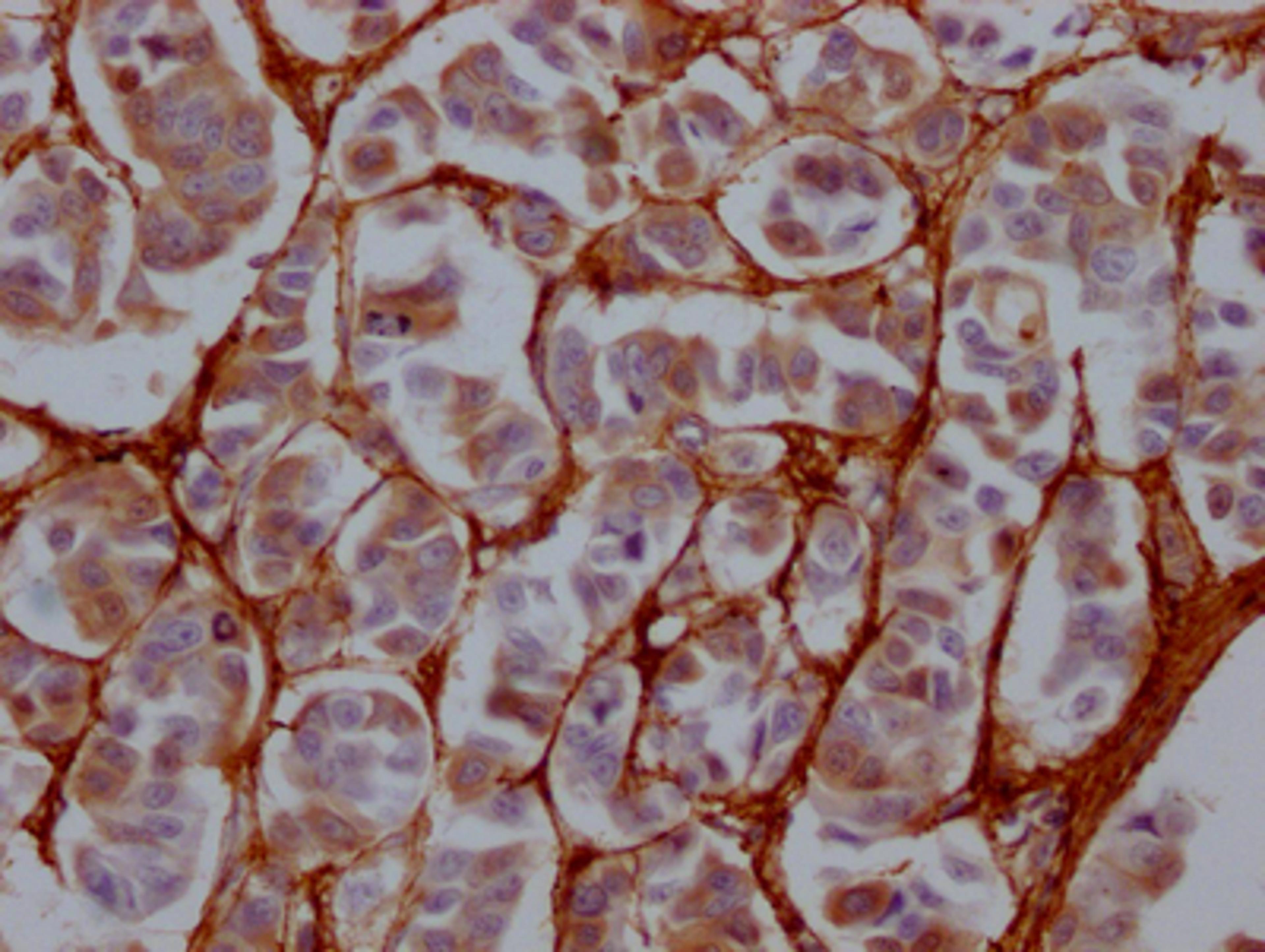 IHC image of CSB-RA921689A0HU diluted at 1:100 and staining in paraffin-embedded human breast cancer performed on a Leica BondTM system. After dewaxing and hydration, antigen retrieval was mediated by high pressure in a citrate buffer (pH 6.0). Section was blocked with 10% normal goat serum 30min at RT. Then primary antibody (1% BSA) was incubated at 4℃ overnight. The primary is detected by a Goat anti-rabbit IgG polymer labeled by HRP and visualized using 0.05% DAB.