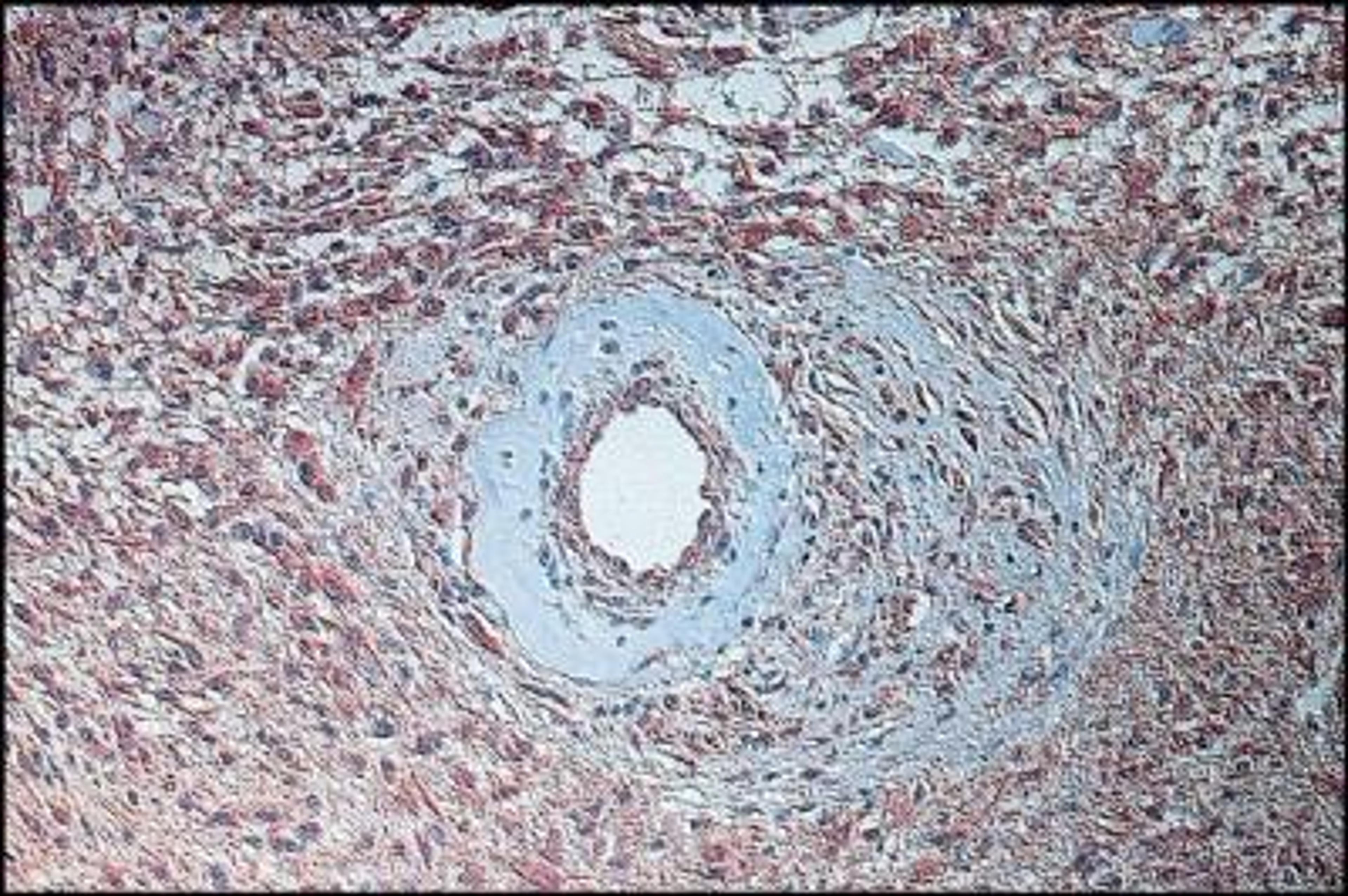 Immunohistochemistry: FGF basic/FGF2 Antibody [NB600-1536] - Immunoperoxidase staining (PAP) of a fibrillary differentiated astrocytoma (WHO grade I, SAMS grade 1) using Rabbit Anti-Fibroblast Growth Factor-Basic. High bFGF expression is shown within tumor cells as well as within endothelial cells .