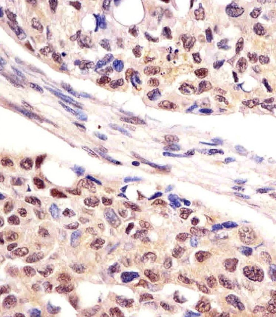 Antibody staining UCHL1 in human lung adenocarcinoma tissue sections by Immunohistochemistry (IHC-P - paraformaldehyde-fixed, paraffin-embedded sections).