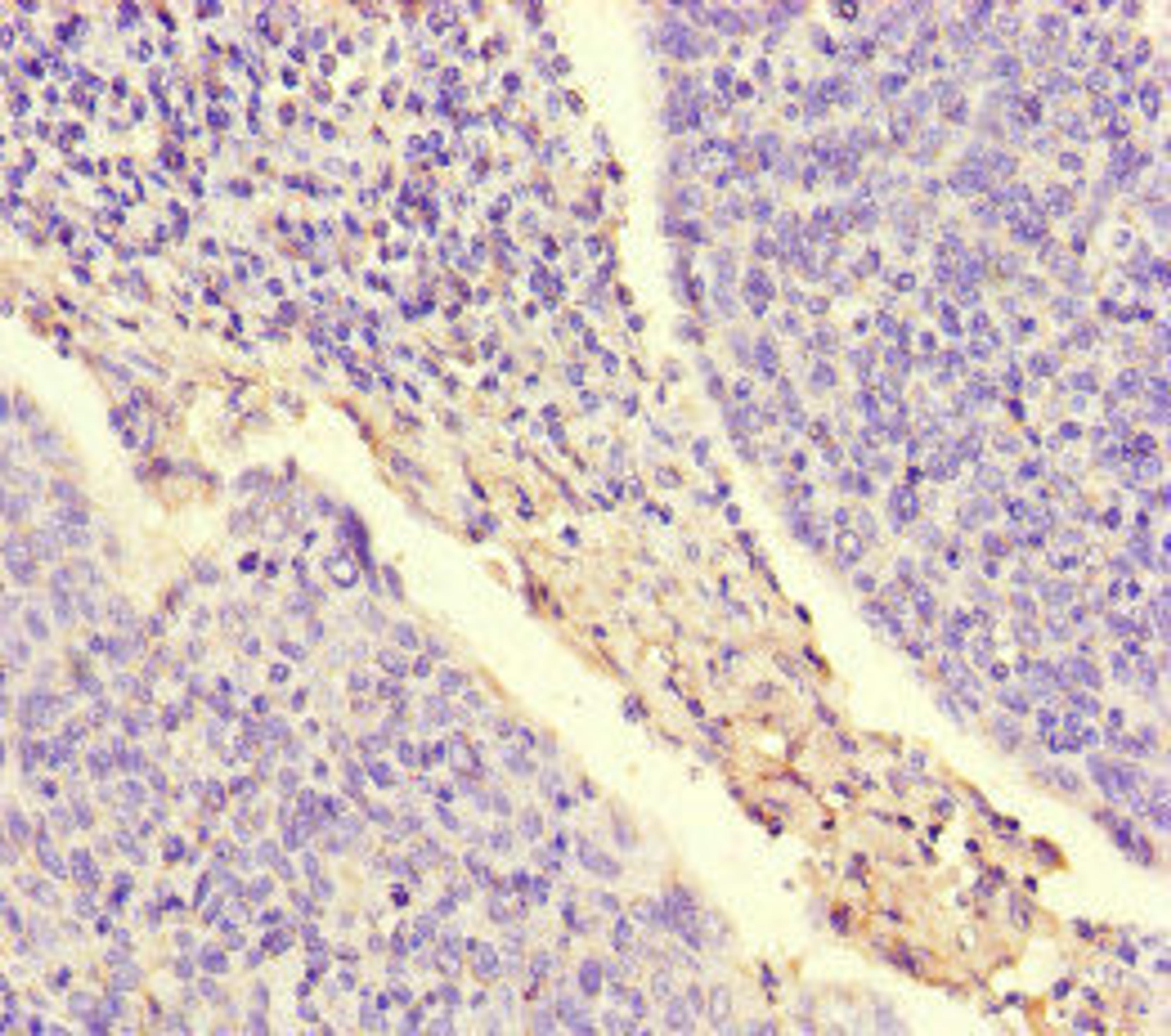 Immunohistochemistry of paraffin-embedded human cervical cancer using CSB-PA01679A0Rb at dilution of 1:100