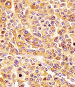 Antibody staining CD63 in human melanoma tissue sections by Immunohistochemistry (IHC-P - paraformaldehyde-fixed, paraffin-embedded sections).