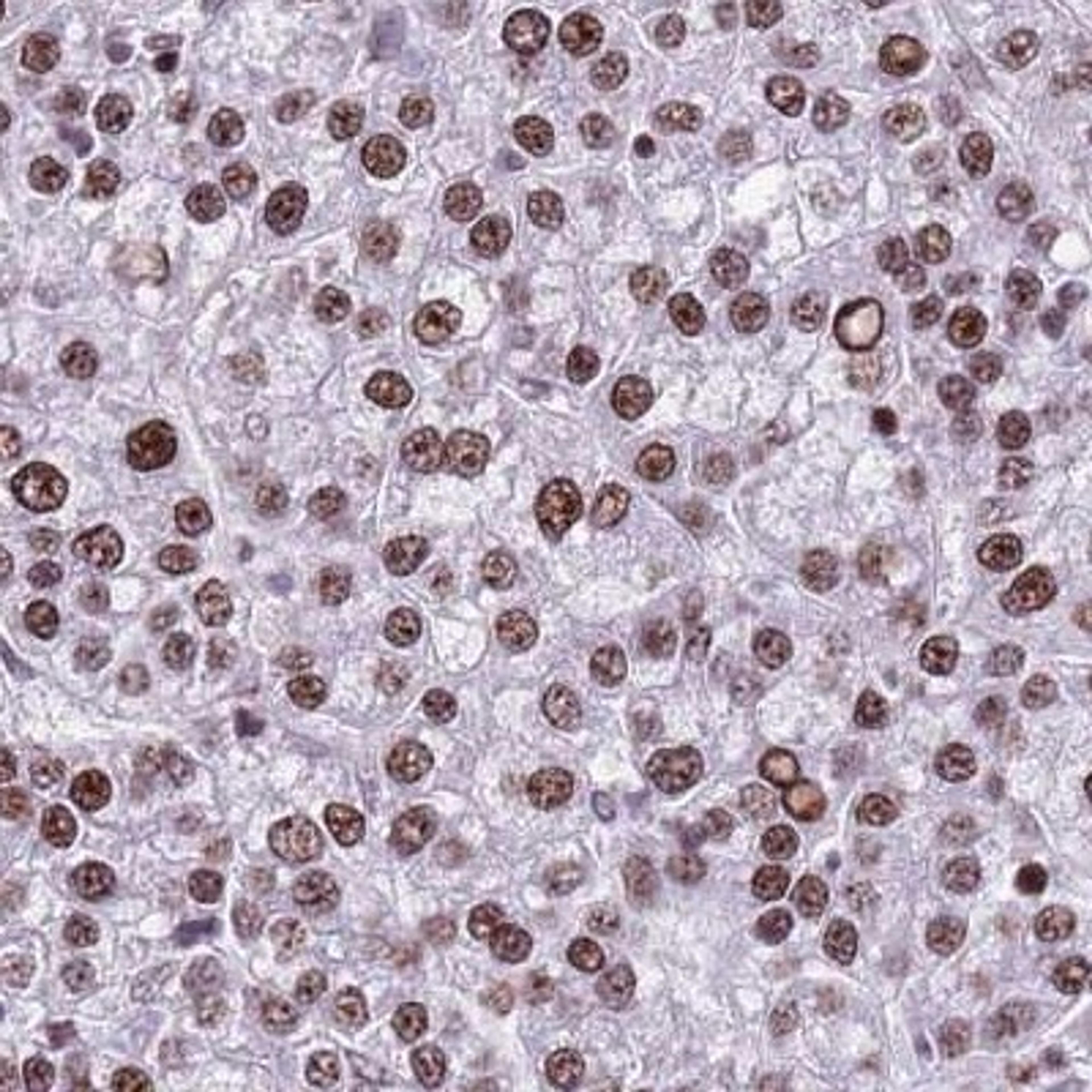 Immunohistochemistry: KIAA1033 Antibody [NBP2-47409] - Analysis of liver cancer tissue.