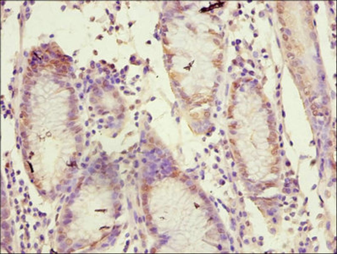 Immunohistochemistry of paraffin-embedded human gastric cancer using CSB-PA07019A0Rb at dilution of 1:100