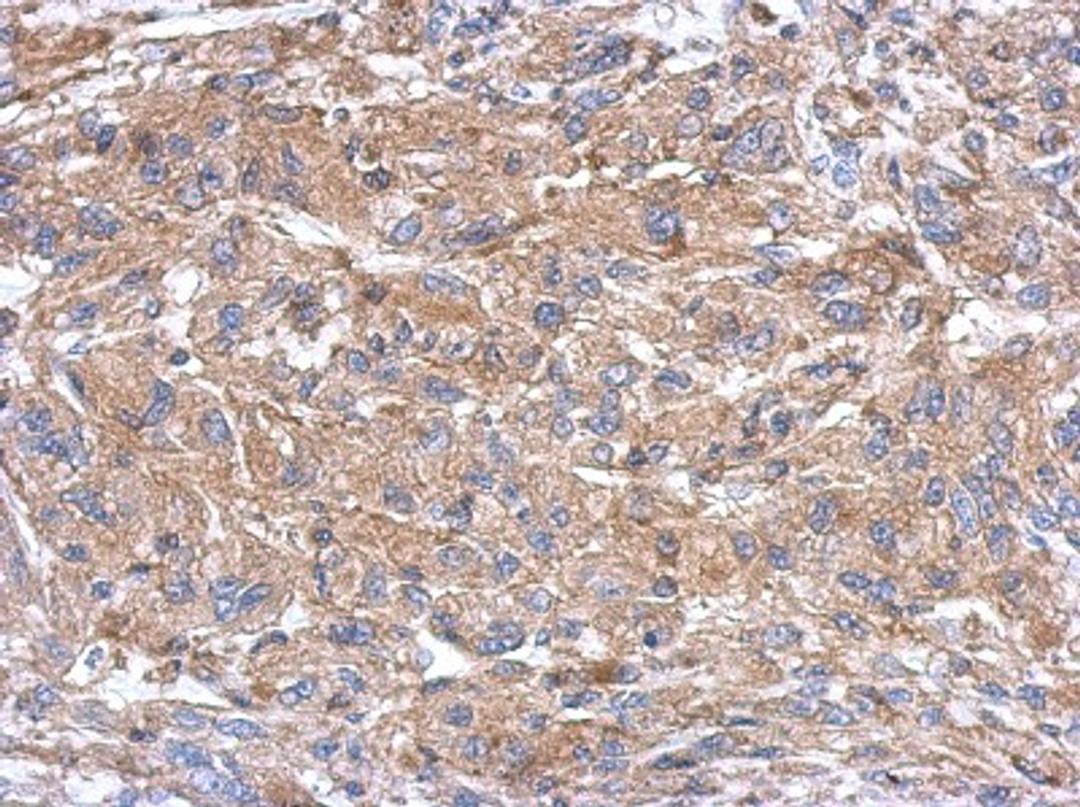 Immunohistochemistry-Paraffin: SEMA4B Antibody [NBP2-19299] - Immunohistochemical analysis of paraffin-embedded U373 xenograft, using antibody at 1:500 dilution.