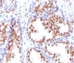 Formalin-fixed, paraffin-embedded human prostate carcinoma stained with Androgen Receptor antibody (DHTR/882).