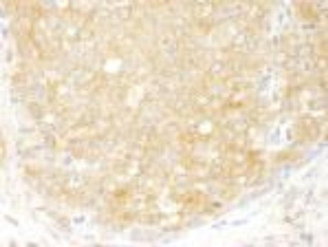 Immunohistochemistry-Paraffin: EIF2 beta Antibody [NB100-93284] - FFPE section of human breast carcinoma.  Affinity purified rabbit anti-eIF2beta/EIF2S2 used at a dilution of 1:250  DAB staining using Immunohistochemistry Accessory Kit