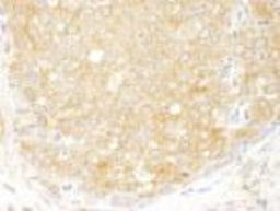 Immunohistochemistry-Paraffin: EIF2 beta Antibody [NB100-93284] - FFPE section of human breast carcinoma.  Affinity purified rabbit anti-eIF2beta/EIF2S2 used at a dilution of 1:250  DAB staining using Immunohistochemistry Accessory Kit