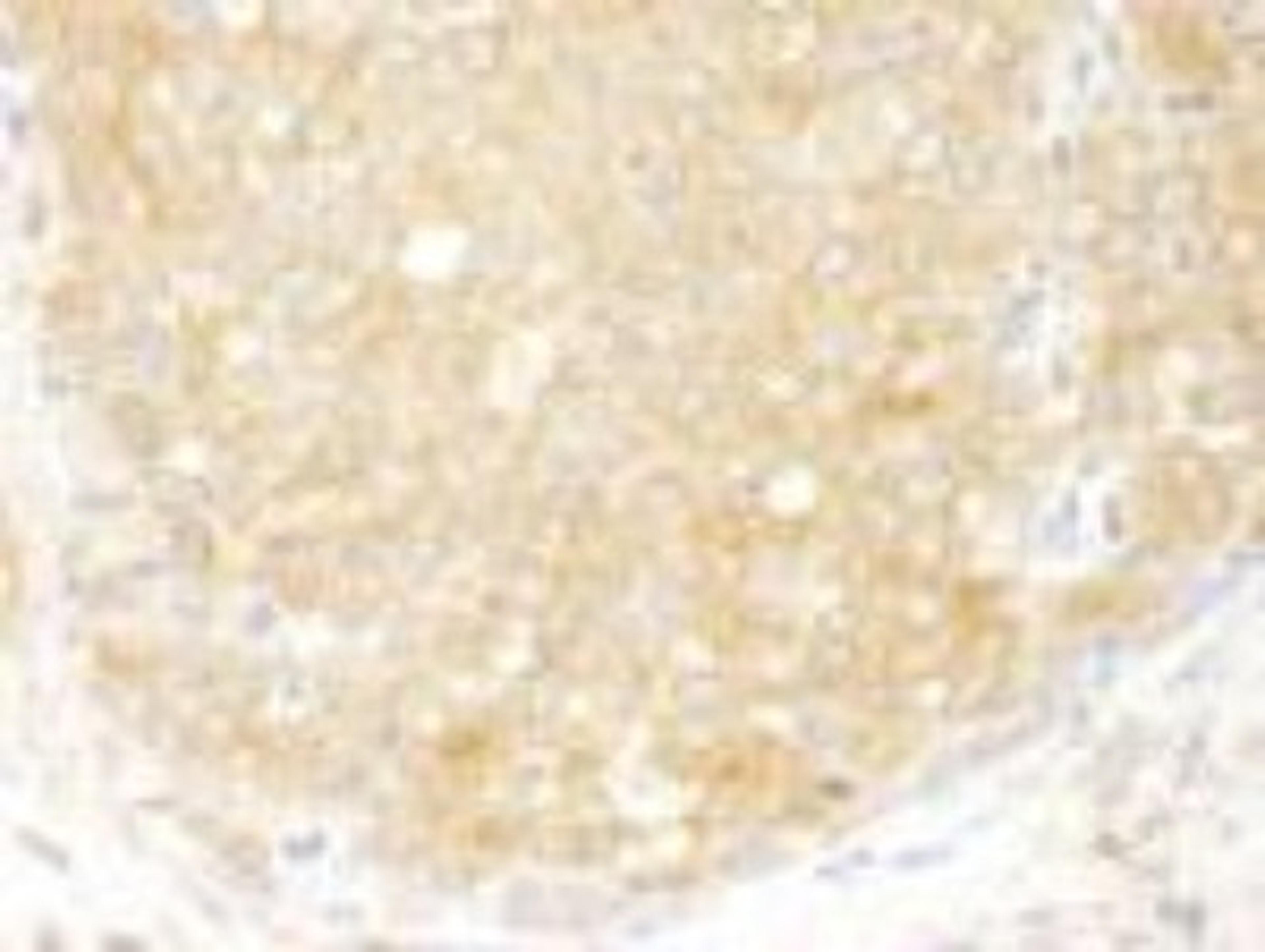 Immunohistochemistry-Paraffin: EIF2 beta Antibody [NB100-93284] - FFPE section of human breast carcinoma.  Affinity purified rabbit anti-eIF2beta/EIF2S2 used at a dilution of 1:250  DAB staining using Immunohistochemistry Accessory Kit